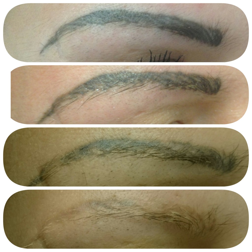 Лазерное удаление татуажа бровей: до и после