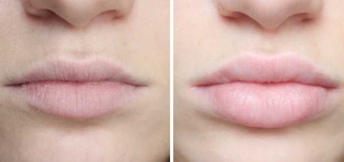 Перманентный макияж губ и гиалуроновая кислота thumbnail