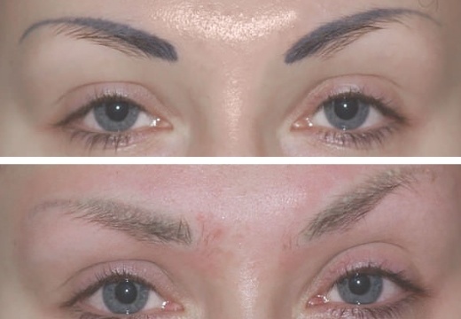 Удаление перманентного макияжа ремувером: результат до и после